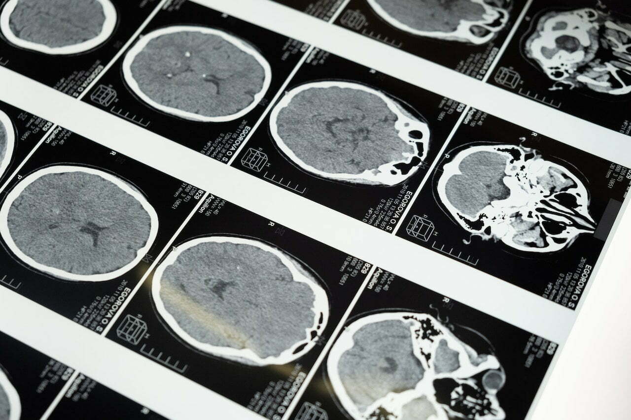 perdida-de-neuronas-afecta-cerebro